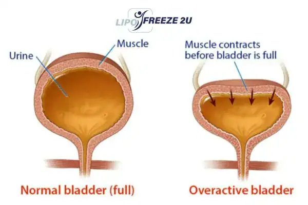 diagram of overactive bladder treatment Scottish