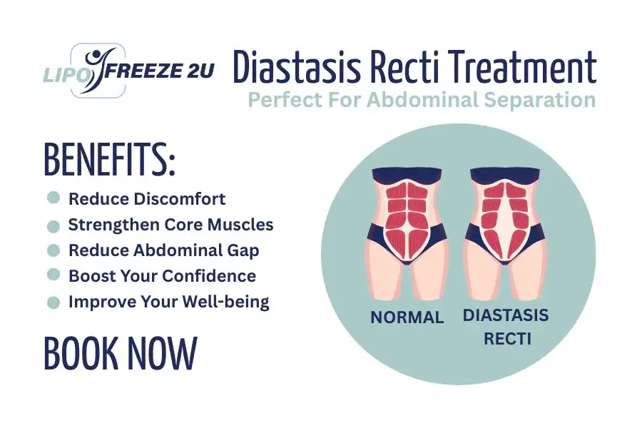 How Long Will It Take to See Improvements in Diastasis Recti Scottish