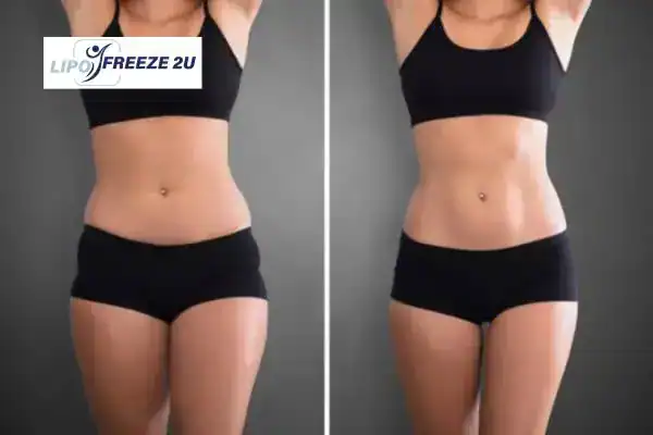 How Can LIPO FREEZE 2U Support Your Post-Pregnancy Body Recovery Scottish?