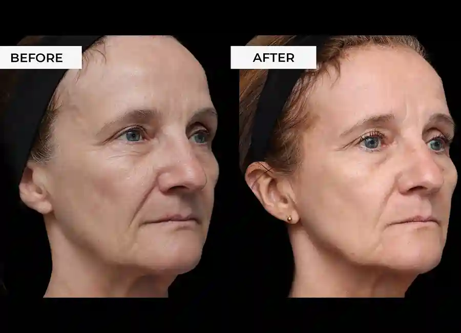 How Many RF Microneedling Sessions Will You Need to See a Difference Scottish?