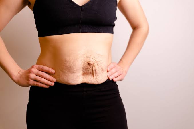 Is Surgery Really the Only Way to Repair Diastasis Recti Scottish?