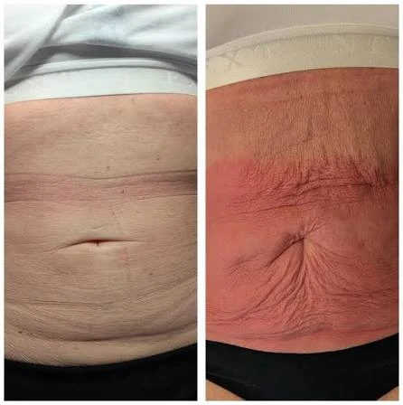 How Does RF Microneedling Improve Crepey, Thin and Uneven Skin Texture Scottish?