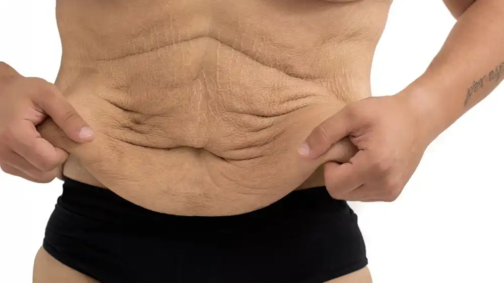 Why Does Weight Loss Medication Leave Some People With Loose or Sagging Skin Scottish?
